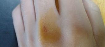 小孩被猫咬需要打狂犬疫苗吗?（被猫咬千万不要打狂犬疫苗）