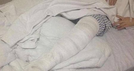 只要是骨折，就是十级伤残吗 只要骨折就十级伤残吗