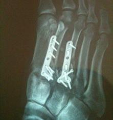 骨折伤残级别鉴定表？ 骨折什么程度算十级伤残