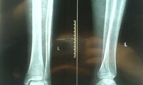 骨折误工费一般赔偿几个月 骨折一般赔偿几个月误工费