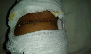 什么叫轻微伤？ 人体轻微伤鉴定标准