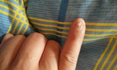 手食指十级伤残标准？ 手指缺失10级伤残图